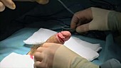 Circumcision surgery