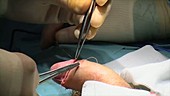 Circumcision surgery