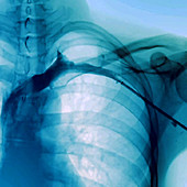 Heart after an angioplasty, angiography