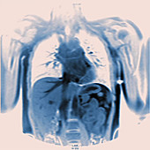 Woman's chest, MRI scans