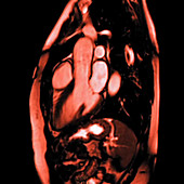 Beating heart, MRI scan