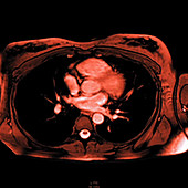 Heart and lungs, MRI scans