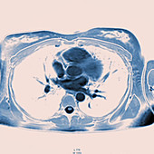 Heart and lungs, MRI scans