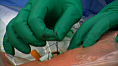 Central line placement, suturing catheter