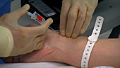Radial line placement, needle insertion