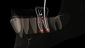 Root canal treatment