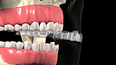 Invisalign teeth aligner