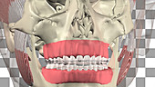 Treatment for unerupted canine tooth