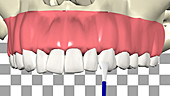 Dental brace fitting