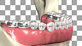 Lower dental braces
