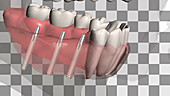 Complete tooth loss