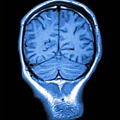 Brain injury, MRI scan sequence