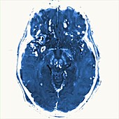 Brain injury, MRI scan sequence