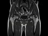 Osteonecrotic hips, MRI scan