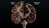 Alzheimer's disease pathology
