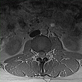 Slipped lumbar disc, MRI sequence