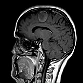 Glioma brain tumour, MRI sequence