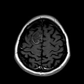 Glioma brain tumour, MRI sequence