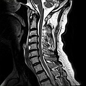 Degenerative cervical spine, MRI sequence