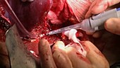 Hepatectomy