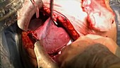 Hepatectomy