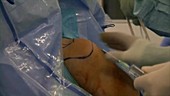 Injection during shoulder arthroscopy