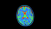 Normal MRI brain scan, axial view
