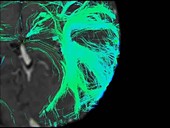 Brain pathways, 3D DTI scan