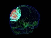 Brain tumour, DTI MRI scan