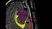 Brain tumour, 3D MRI scan