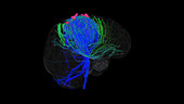 Brain tumour site, 3D DTI scan