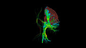 Brain tumour site, 3D DTI scan