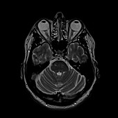 Multiple sclerosis, brain MRI sequence