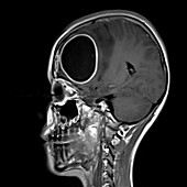 Brain abscess, MRI sequence