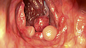 Polyps in a human intestine