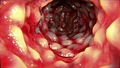 Crohn's disease intestine