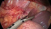 Gastric bypass surgery, endoscope view