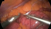 Gastric bypass surgery, endoscope view