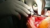 Knee replacement surgery