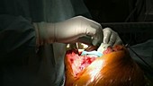 Knee replacement surgery