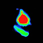 Heart cell death, fluorescence microscopy