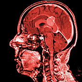 Brain membrane tumour, MRI sequence