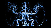 Brain arteries, 3D MRA scan