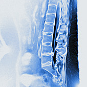 Slipped lumbar disc, MRI sequence
