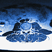 Slipped lumbar disc, MRI sequence