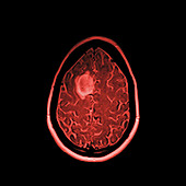 Glioma brain tumour, MRI sequence