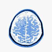 Glioma brain tumour, MRI sequence