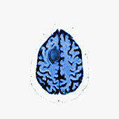 Glioma brain tumour, MRI sequence