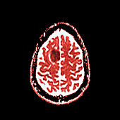 Glioma brain tumour, MRI sequence