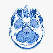 Multiple sclerosis, brain MRI sequence